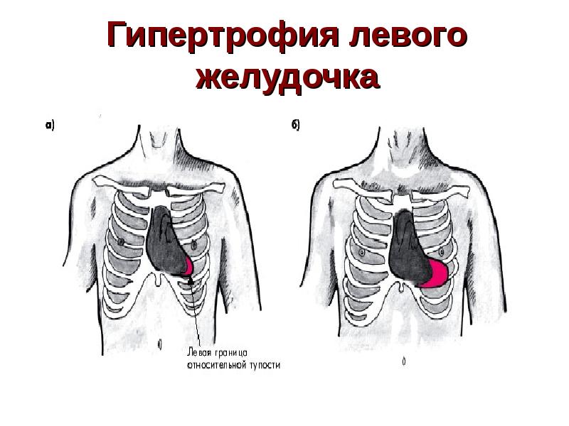 Колит в ребрах при вдохе. Смещение границ относительной тупости сердца влево. Гипертрофия левого желудочка сердца перкуссия. Смещение границ сердечной тупости при гипертрофии. Границы сердечной тупости при гипертрофии левого желудочка.