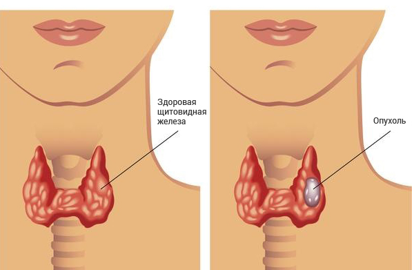 узлы в щитовидной железе