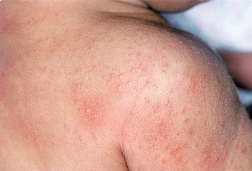 Причины аллергического дерматита
