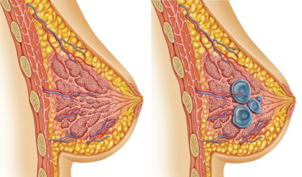 Схема мастопатии в груди