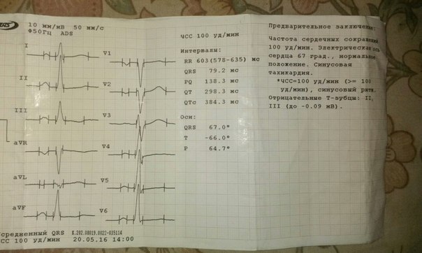 Описание экг