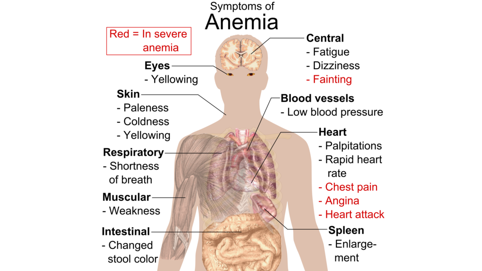Заболевания сопровождающиеся анемией. Симптомы низкого ферритина. Болезни крови симптомы. Клиническая картина анемии.