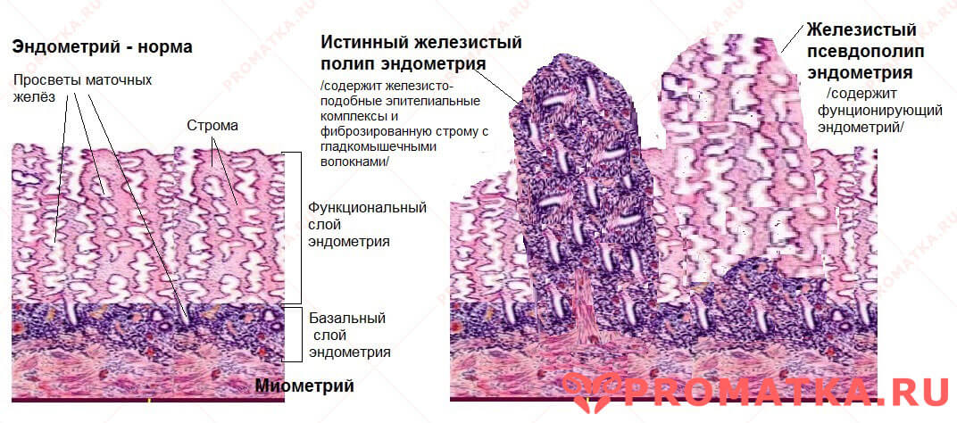 Как выглядит полип на шейке матки фото