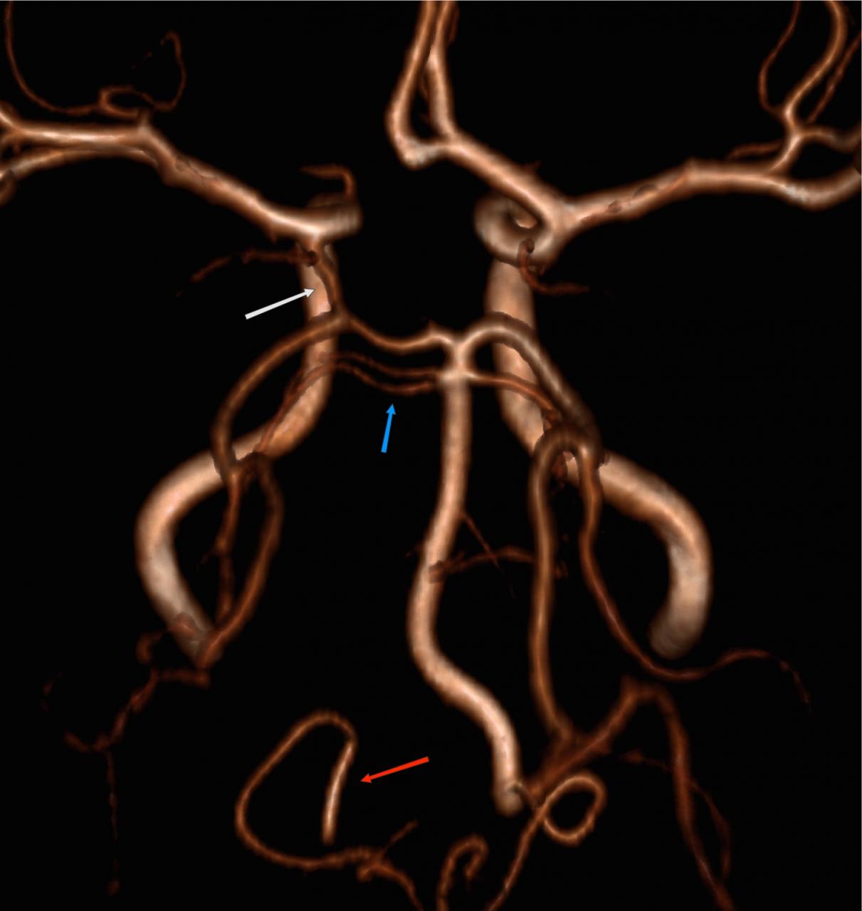 Сегмент v4 правой позвоночной артерии. Гипоплазия позвоночной артерии кт. Гипоплазия правой позвоночной артерии сегменты. Гипоплазия а1 сегмента левой ПМА. Гипоплазия v4 позвоночной артерии.