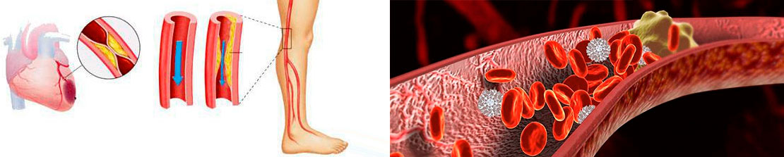 Тромбозы и эмболии артерий. Тромбозы и эмболии периферических артерий. Паразитарная эмболия эмболия. Эмболия периферических сосудов. Тромбоз и эмболия и атеросклероз.