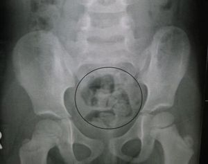 Рентгеновский снимок запора