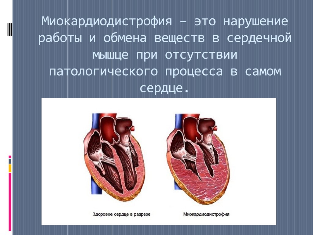 Изменения миокарда левого желудочка сердца. Миокардиодистрофия эхокардиография. Миокардиодистрофия (дистрофия миокарда). Дистрофия сердечной мышцы.