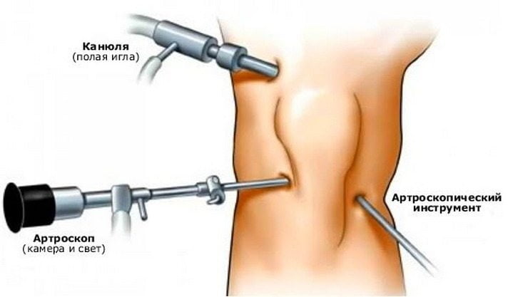 Артроскопия колена 