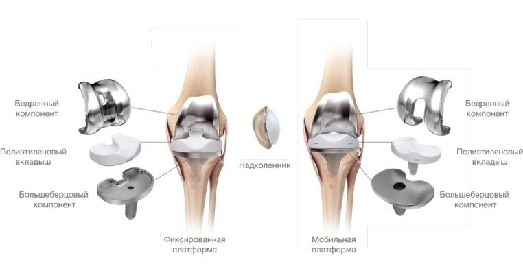 Протезирование колена 