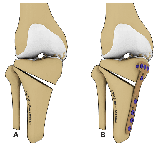 Артроскопия колена 