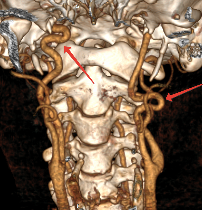 Артерии шейного отдела позвоночника. Синдром позвоночной артерии кт. Аномалия Киммерли ангиография. Кт ангиография сонных артерий. Позвоночная артерия кт.