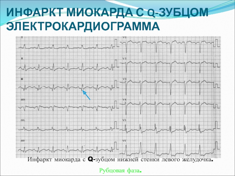 Изменения миокарда