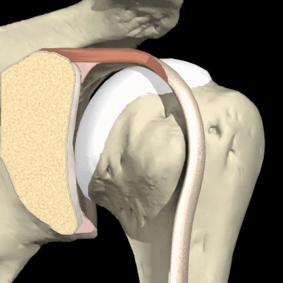 Разрыв губы гленоида. Ротаторная манжета тазобедренного сустава. Гленоида лопатки анатомия. Реверсивное эндопротезирование плечевого сустава. Хрящевая губа плечевого сустава.