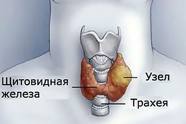 Как выглядит узел щитовидной железы фото