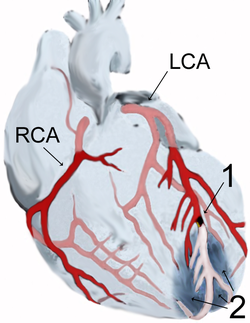 Диаграма на инфаркт на миокарда (2), след запушване (1) на капиляри в лявата коронарна артерия (LCA), дясна коронарна артерия (RCA)