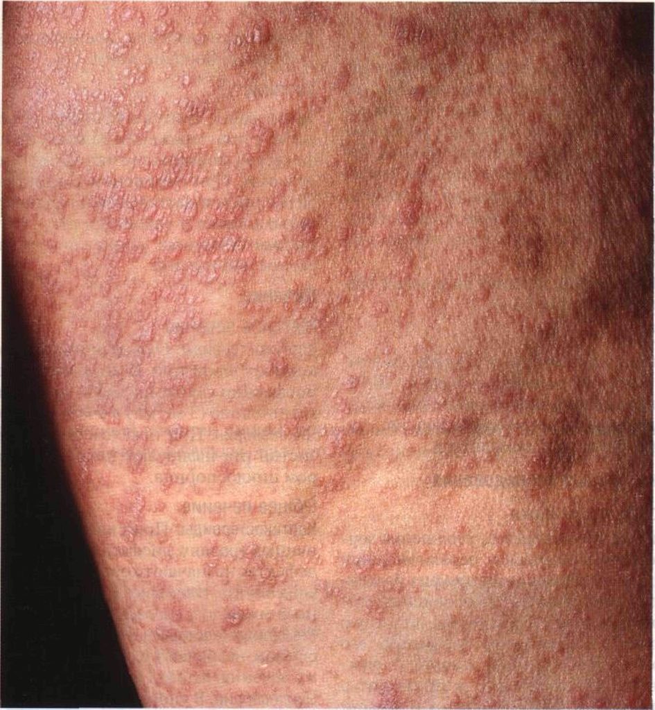 Сифилитическая сыпь фото у мужчин и симптомы