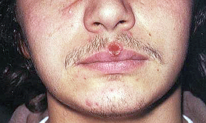 Сифилитическая сыпь фото у мужчин и симптомы шанкр