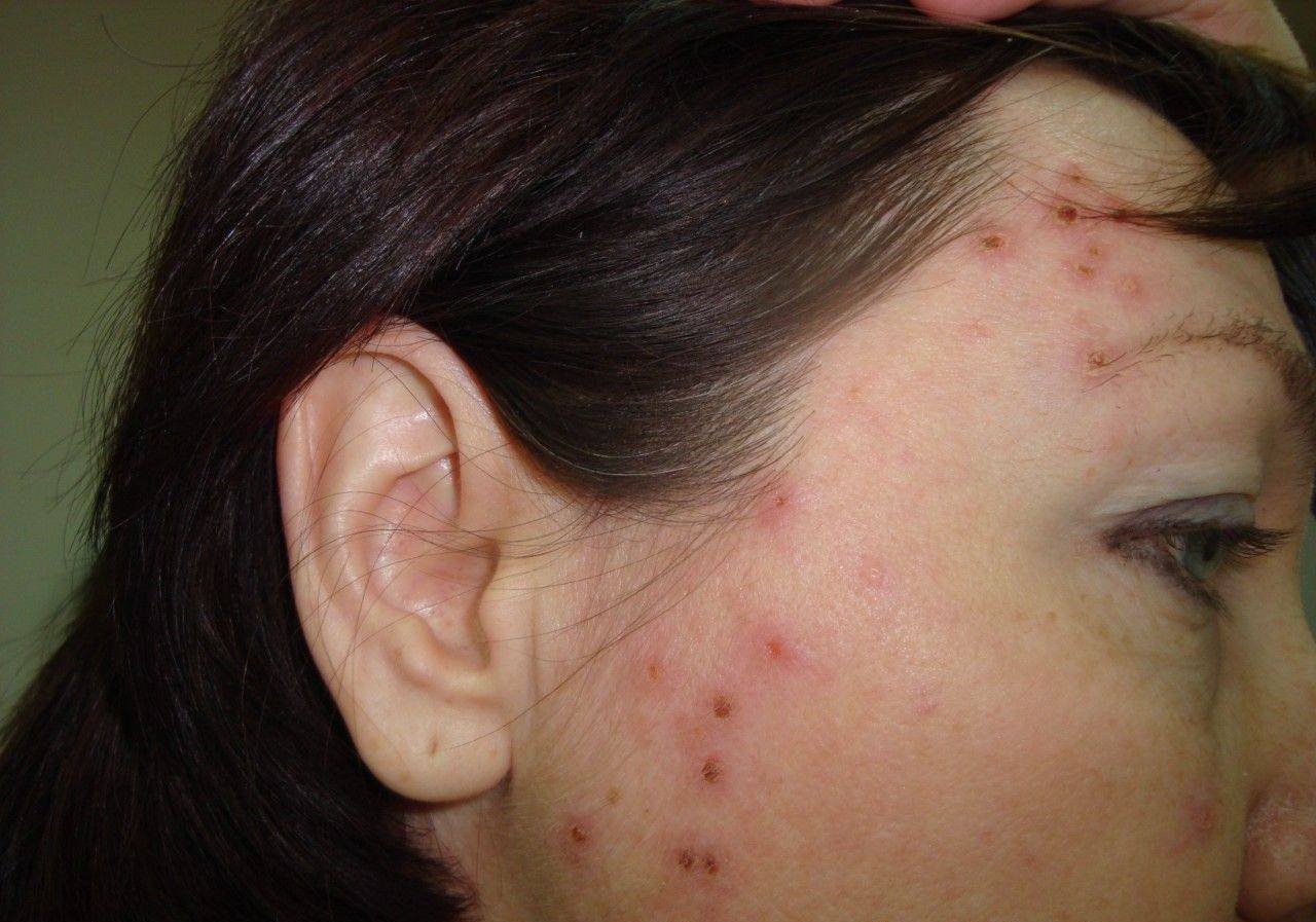 Сифилитическая сыпь фото у женщин и симптомы