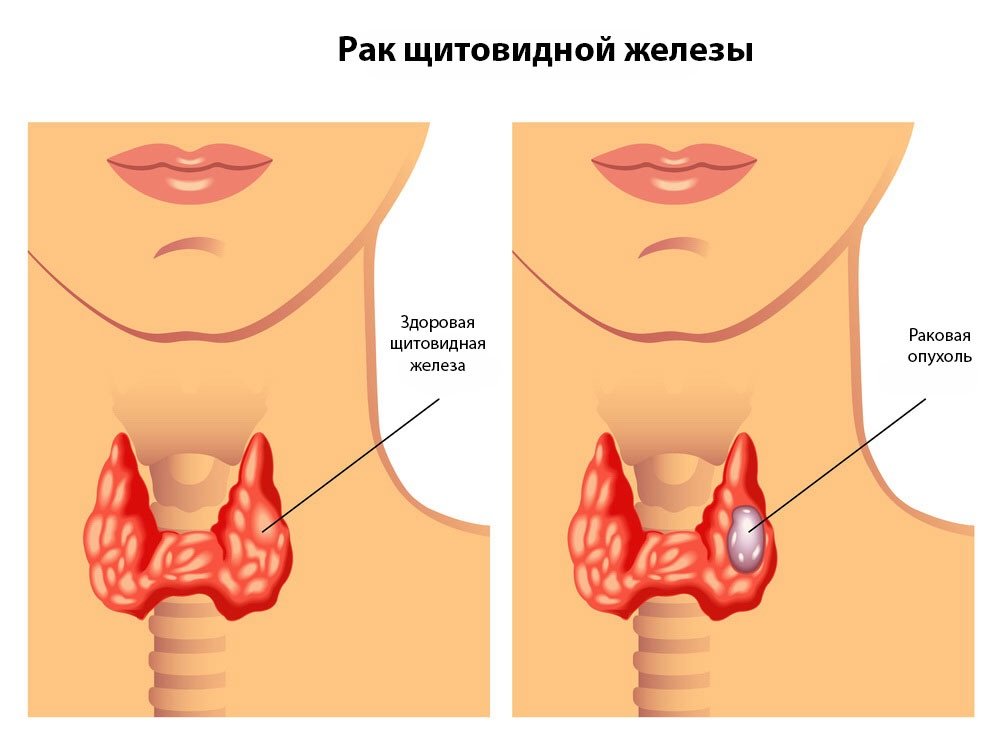 Папиллярный рак щитовидной железы симптомы у женщин, фото