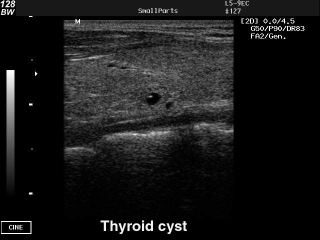 Киста щитовидной у мужчин. Атлас УЗИ щитовидной железы. Коллоидная киста щитовидной. Кистозно расширенный фолликул щитовидной железы на УЗИ.