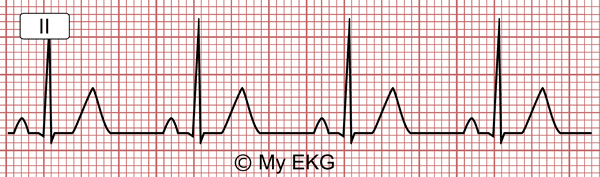 Normal Sinus Rhythm on the Electrocardiogram