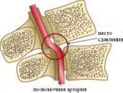 Особенности гипоплазии позвоночной артерии справа и слева