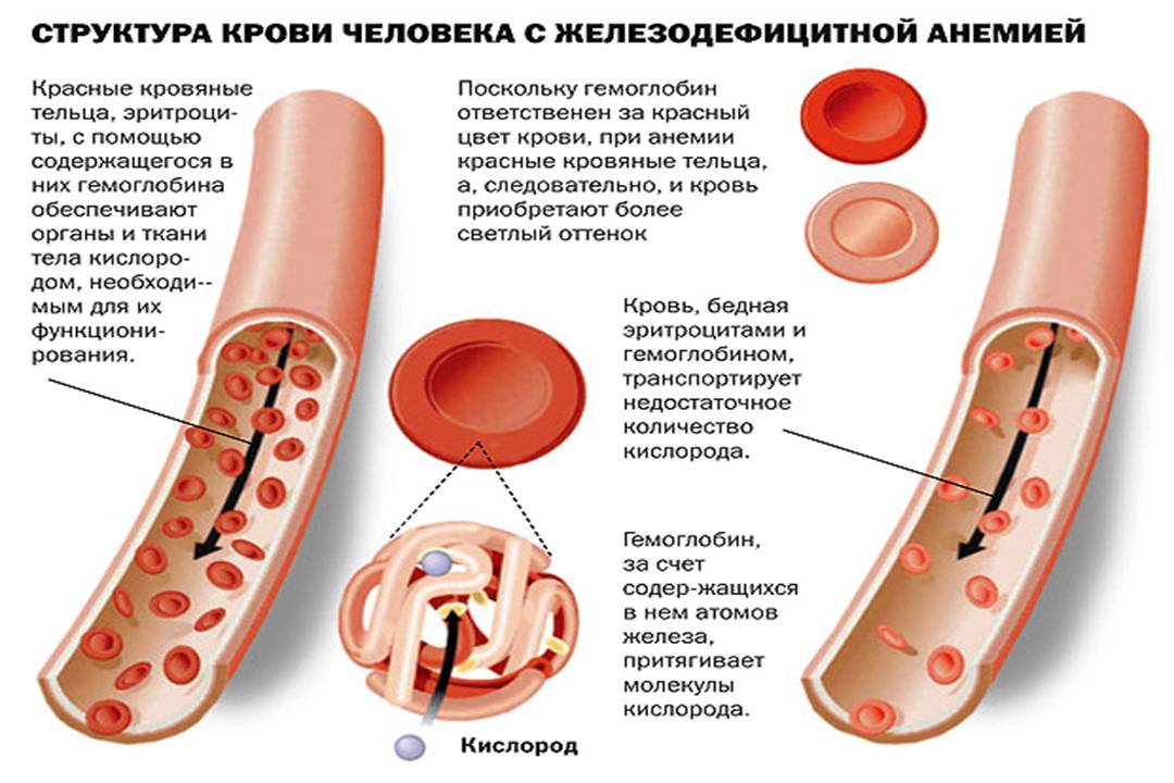 Почему в организме низкий гемоглобин. Железодефицитная анемия проявления. Анемия железа. Анемия низкий гемоглобин. Развитие железодефицитной анемии.