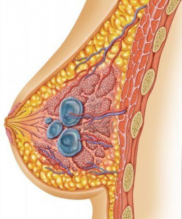 киста молочной железы 