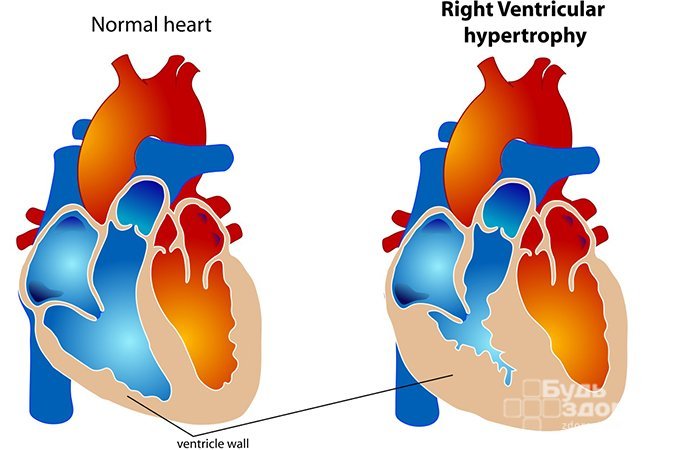 Эксцентрическая гипертрофия левого желудочка сердца