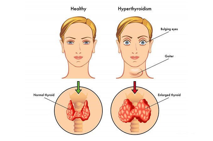 Перепады артериального давления - один из симптомов диффузных изменений щитовидной железы