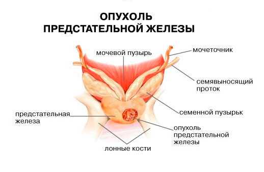 Онкологии предстательной железы у мужчин. Новообразование предстательной железы. Опухание предстательной железы. Отек предстательной железы. Опухоль предстательной железы у мужчин.